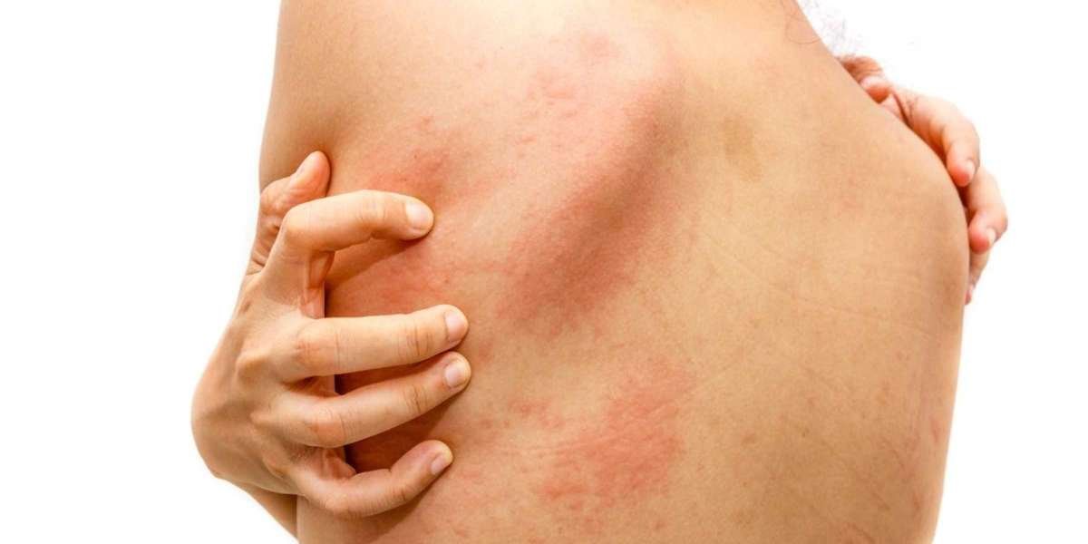 Fungal skin infections: Types, symptoms and treatment