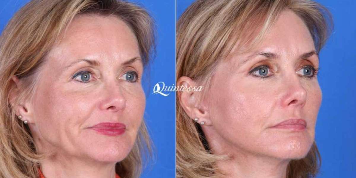 Understanding a Facelift