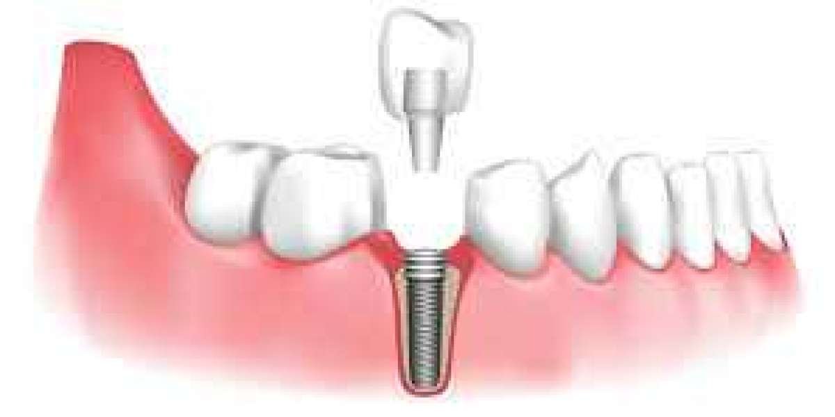 Restore Your Smile with Dental Implants in Singapore