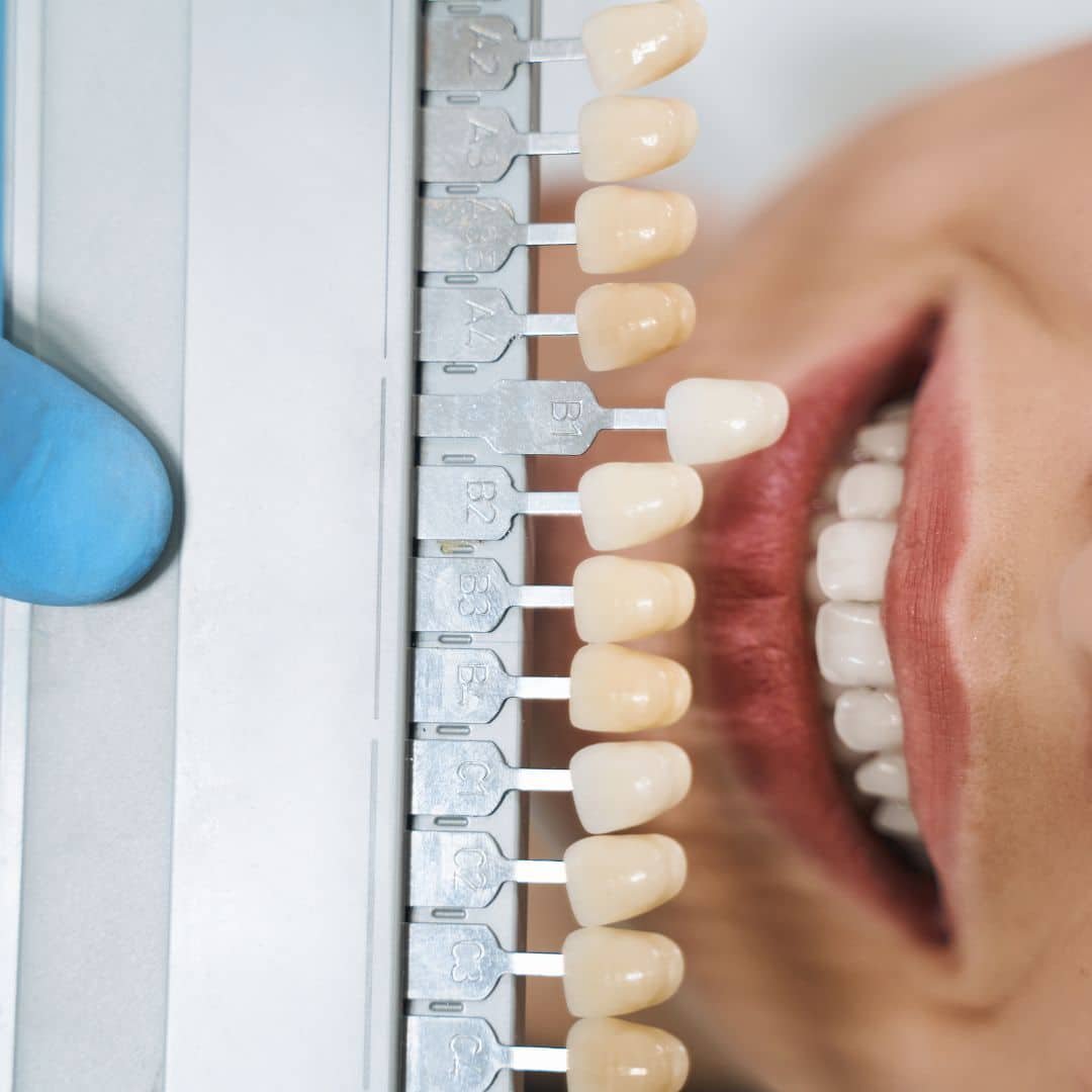 Dental Lumineers: Get Revolutionary Smile Transformation in Turkey